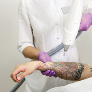 Read more about the article Sinar Laser untuk Menghapus Tato