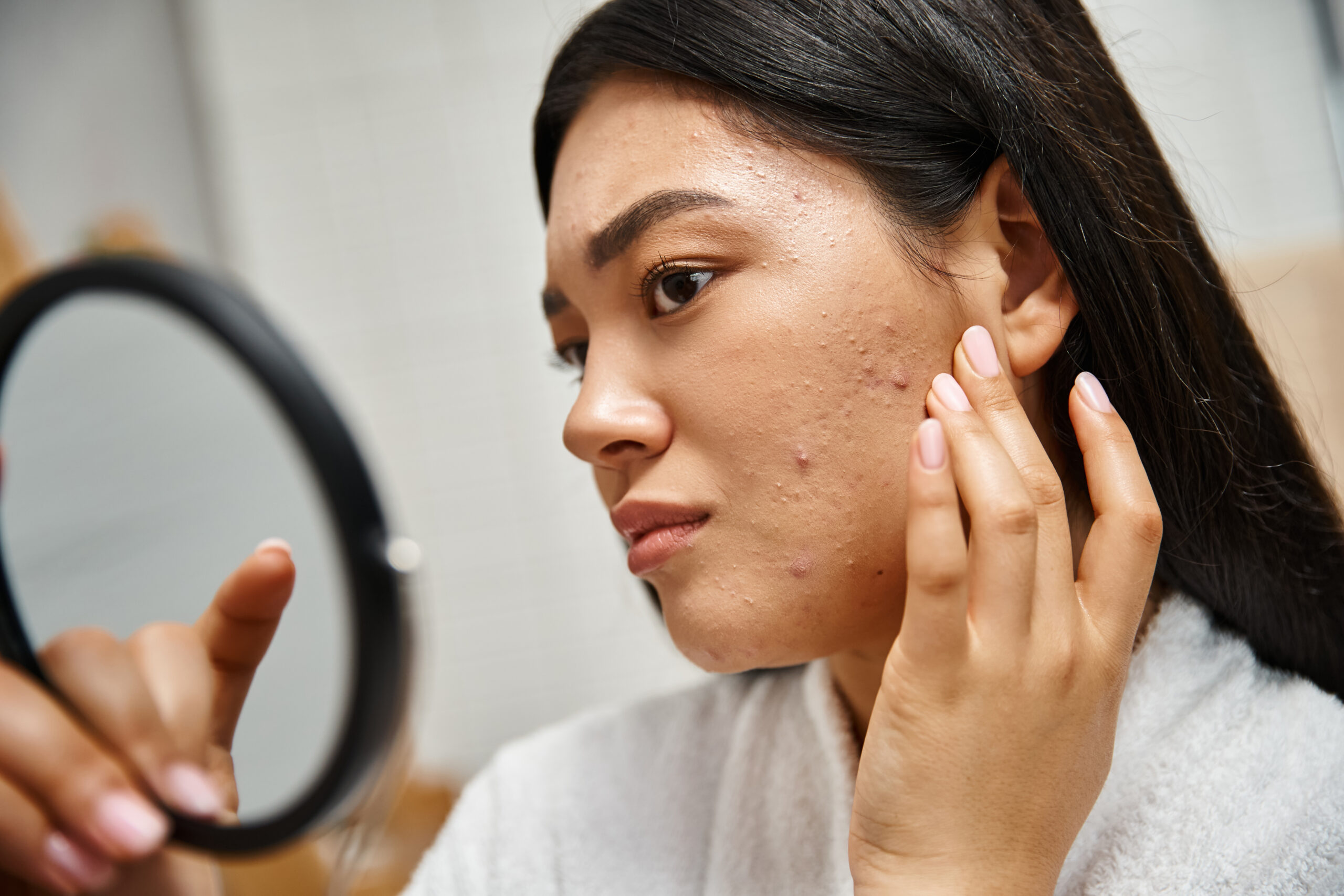 Read more about the article Udah Coba Semua Skincare tapi Jerawat Masih Bandel? Ini Solusinya!